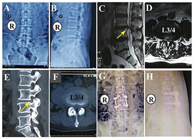 Oblique Lateral Interbody Fusion vs. Minimally Invasive Transforaminal Lumbar Interbody Fusion for Lumbar Spinal Stenosis: A Retrospective Cohort Study